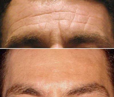 Before and After BOTOX in Philadelphia, PA