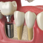 Dental Implant Procedure graphic example