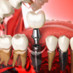 Restoring Your Smile and Confidence with Dental Implants-Absolute Smile
