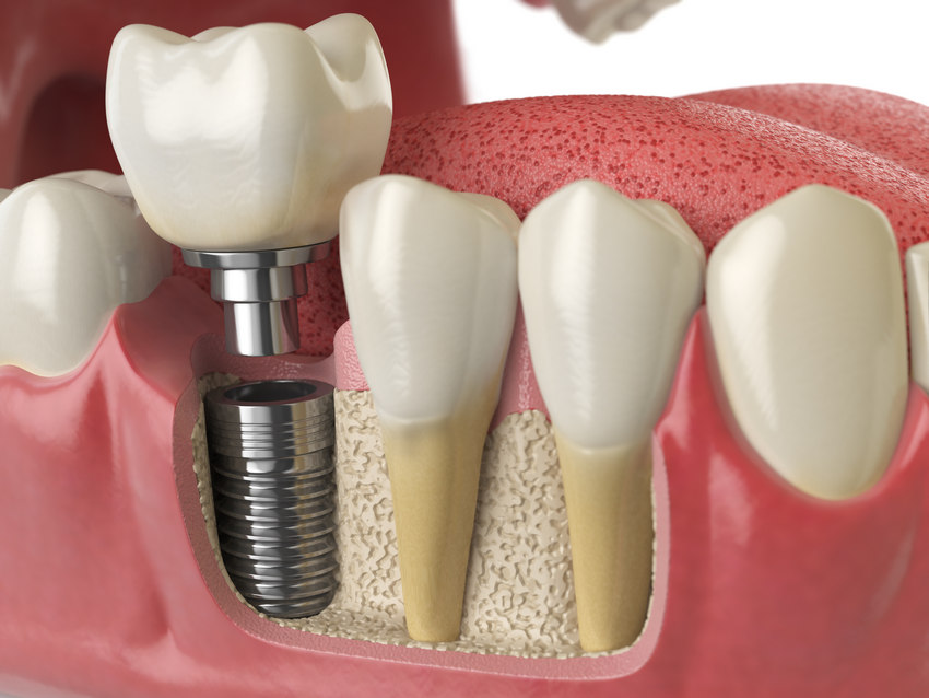 Dental Implant Procedure-Absolute Smile