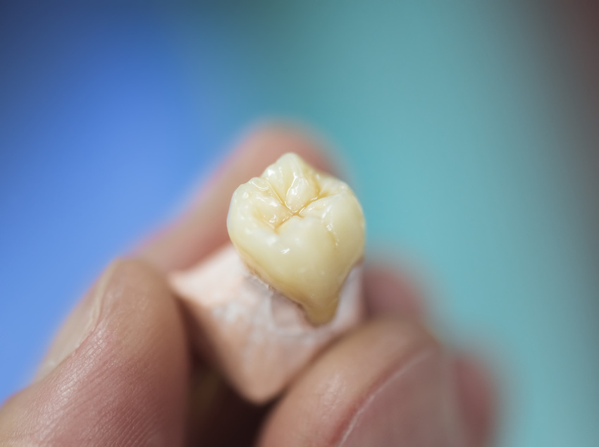 Everything You Need to Know About Dental Implants 1-Absolute Smile