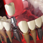 Dental Implants-Absolute Smile