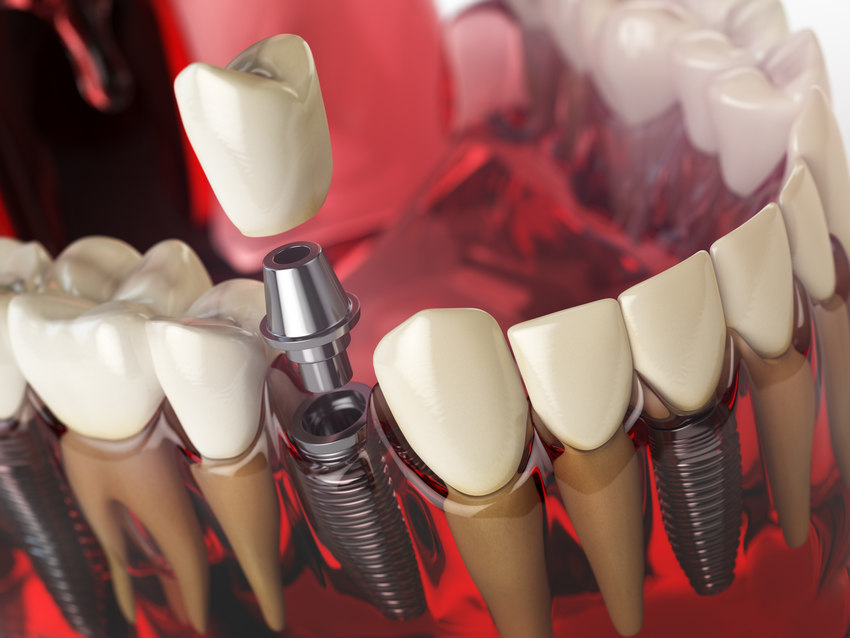 Teeth that Make You Proud: 4 Benefits of Dental Implants-Absolute Smile