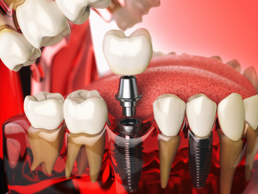 Restoring Your Smile and Confidence with Dental Implants-Absolute Smile