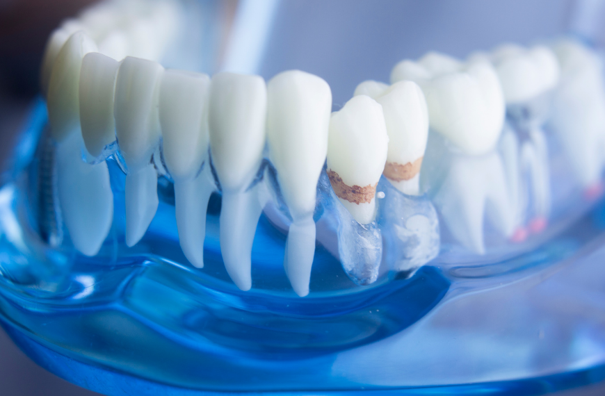 What Is Dental Plaque – And How Do I Get Rid of It?
