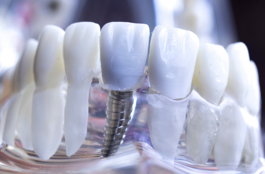 Which Type of Dental Implants Are Right for You?