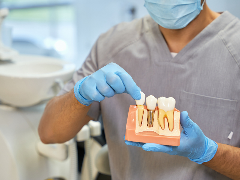 Reasons to Consider Dental Implants