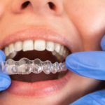 What Is Invisalign Treatment? 