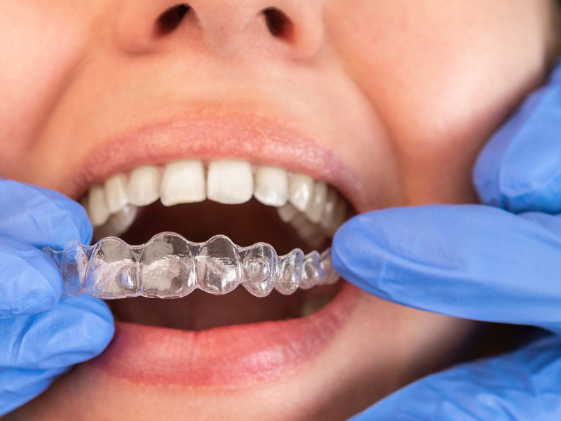 What Is Invisalign Treatment? 