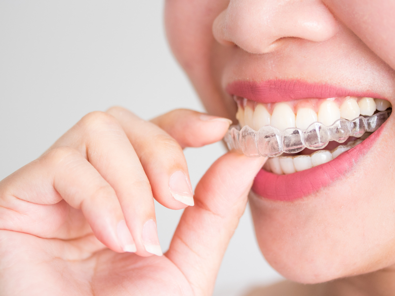 What Is Invisalign Treatment? 
