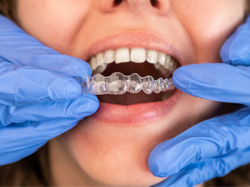 Benefits of Invisalign