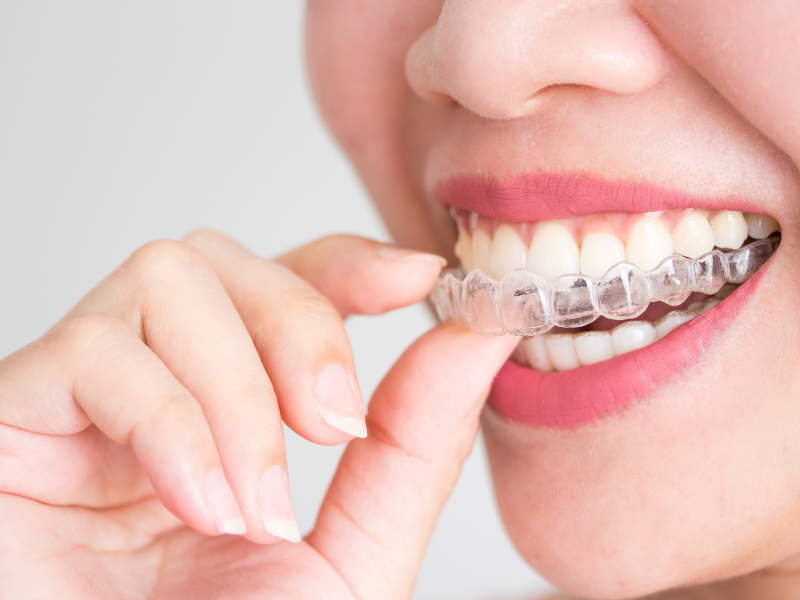 Invisalign vs. Braces