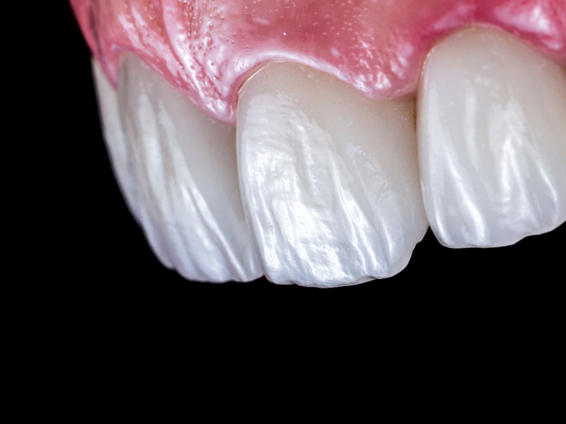 Porcelain Veneers in Philadelphia