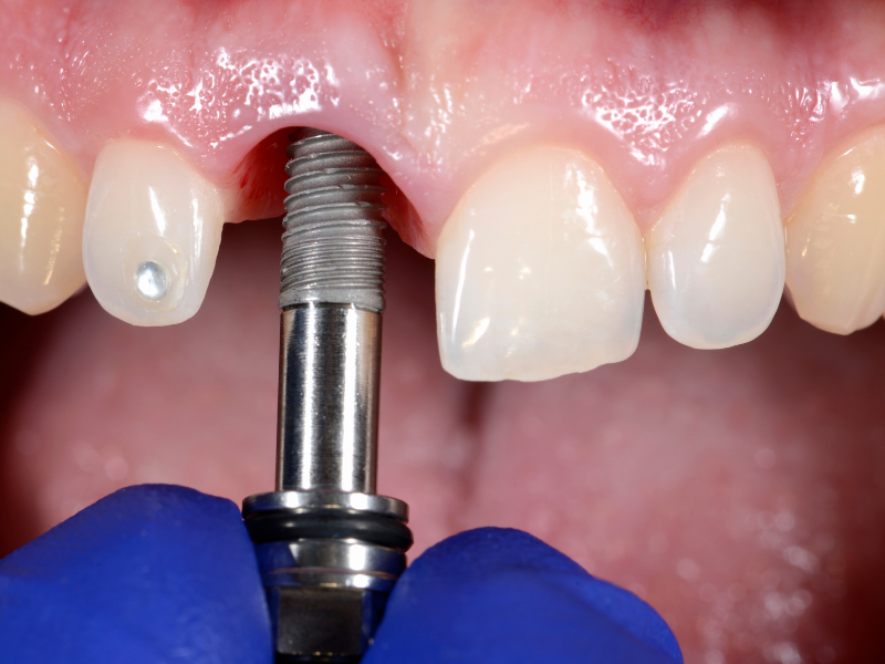 Implant Dentistry in Southampton