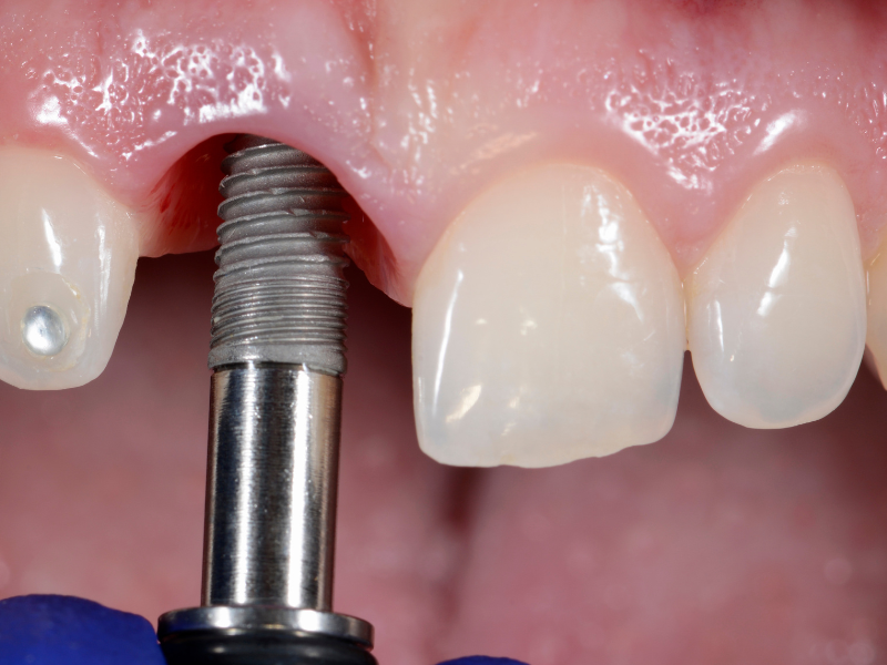Dental implants in Bucks County