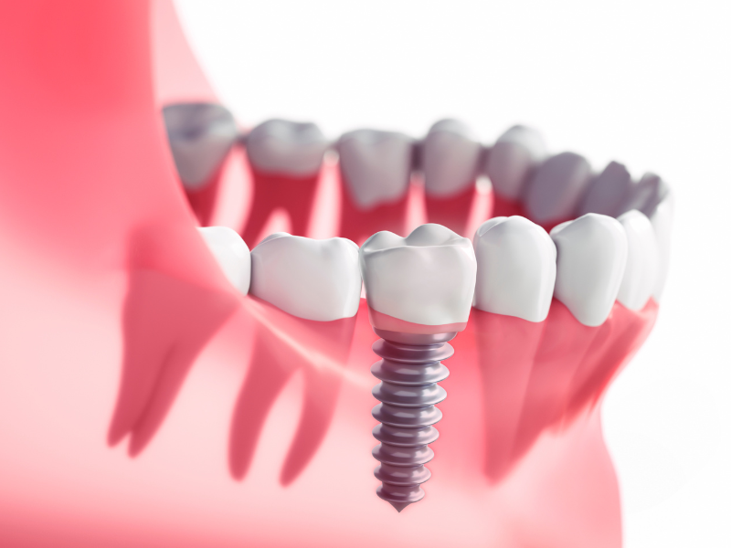 Dental Implants in Philadelphia