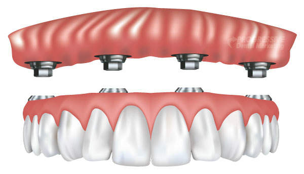 Implanted Supported Dentures - Philadelphia, PA