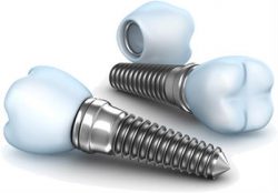 Replacing Missing Teeth with Dental Implants