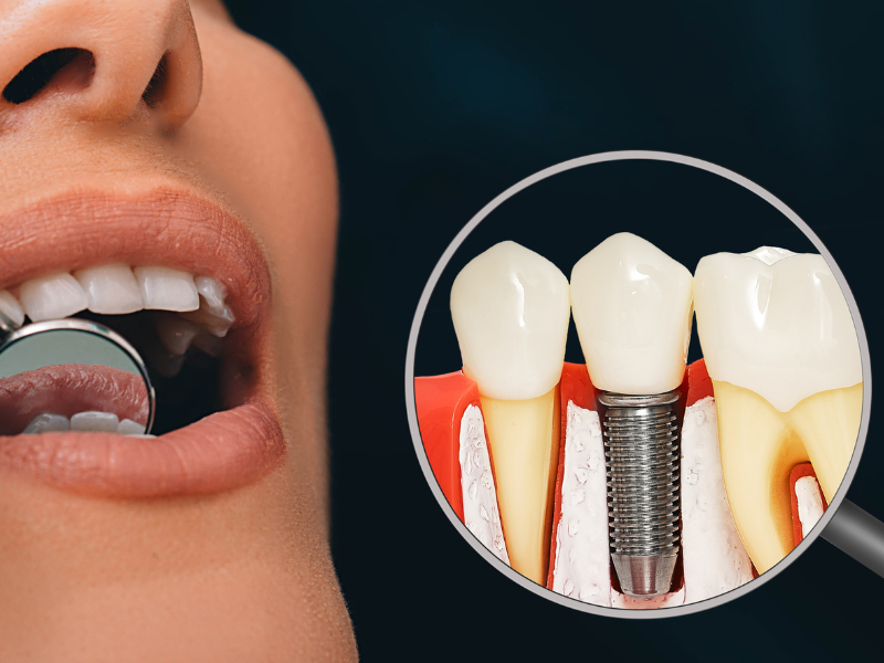 Implant Dentistry Philadelphia