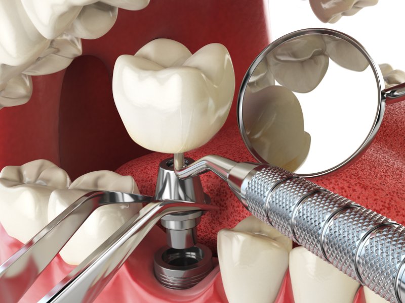Implant Dentistry Philadelphia