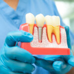 dental-implants-in-philadelphia-pa-close-up-titanium-posts-and-artificial-teeth