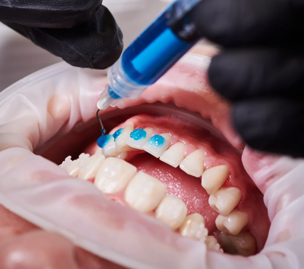 Close-up of dental professional applying whitening gel during in-office teeth whitening procedure.