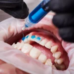 Close-up of dental professional applying whitening gel during in-office teeth whitening procedure.