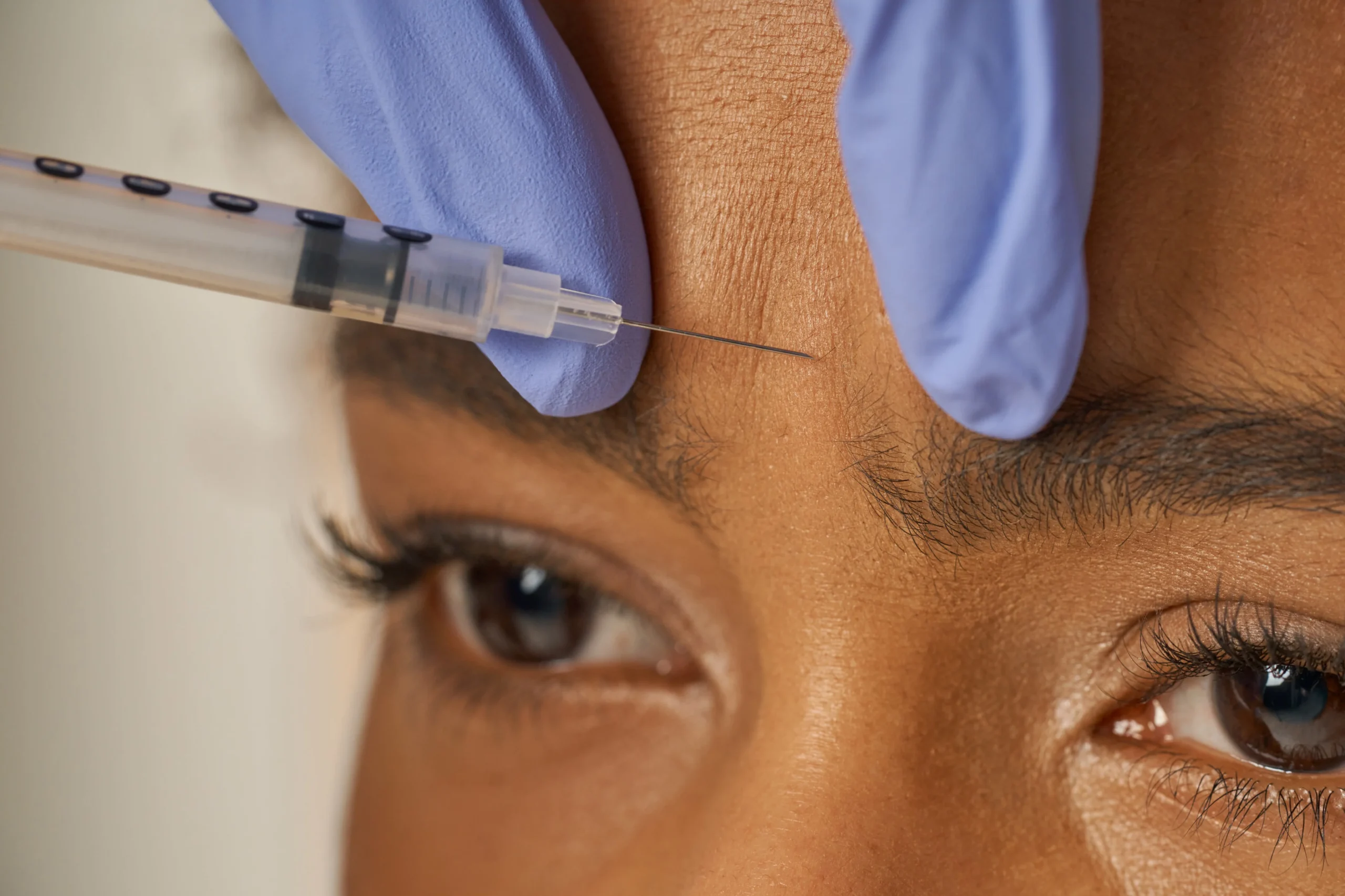 Close-up of Botox injection in the forehead to relax wrinkles and minimize pores.