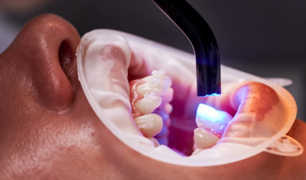Patient with braces undergoing laser dental treatment for cavity care.