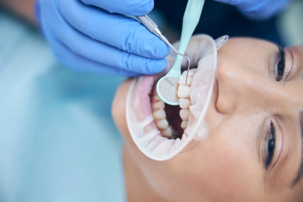 Dentist performing traditional dental filling using mirror and dental tools.