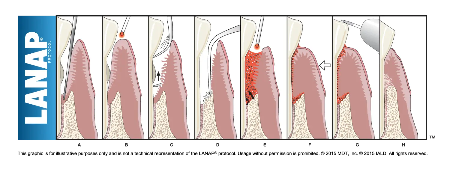 Laser Dentistry in Philadelphia