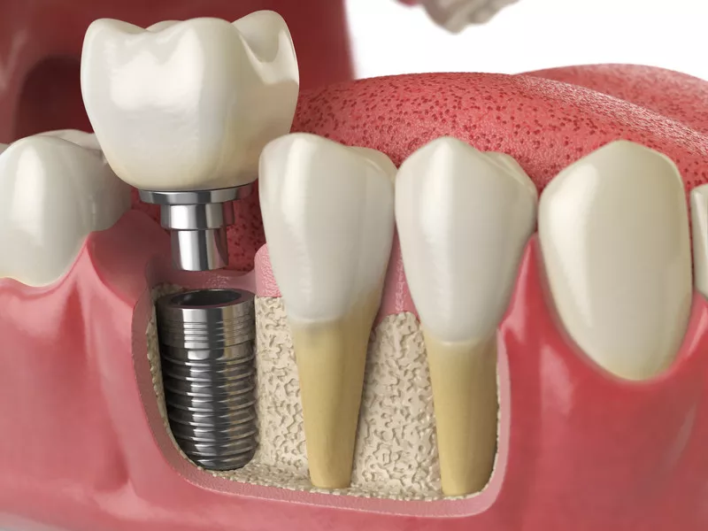 Dental Implant Procedure graphic example