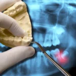 Dental model and x-ray highlighting impacted wisdom teeth.