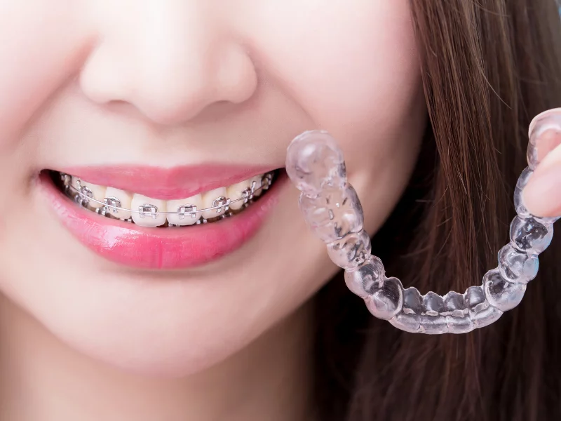 Invisalign vs. Braces