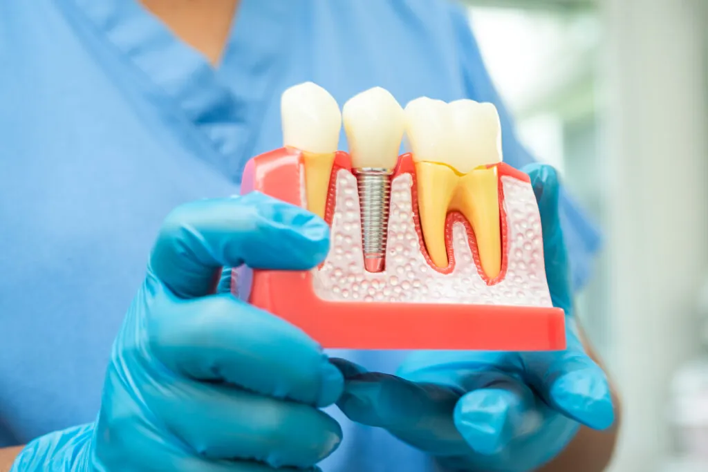 dental-implants-in-philadelphia-pa-close-up-titanium-posts-and-artificial-teeth