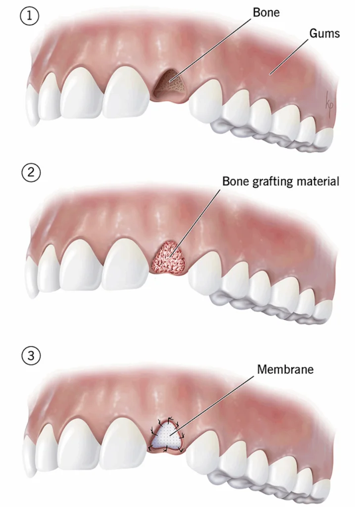 Dental Bone Augmentation and Reconstruction in Philadelphia, PA
